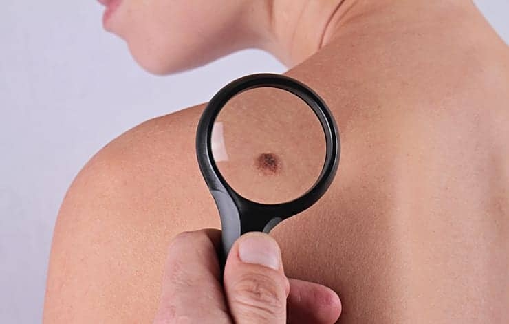 6 Skin Cancer Warning Signs That Are Easy to Overlook