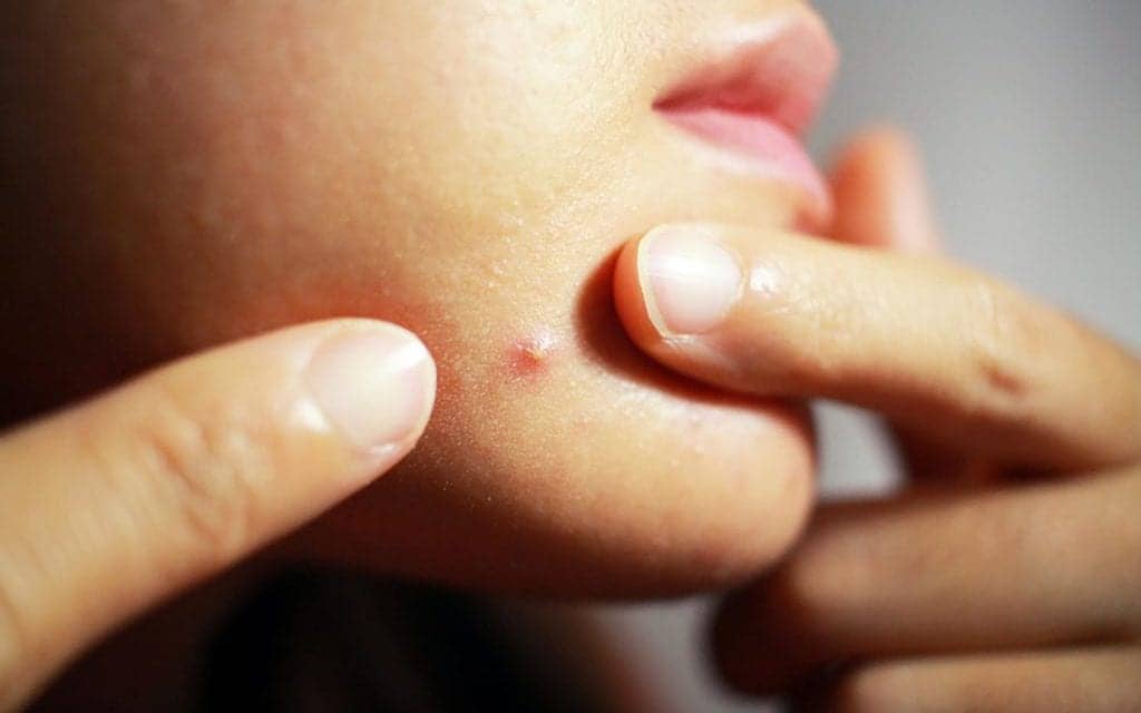 Why You Get Chin Acne—and How to Clear It Up