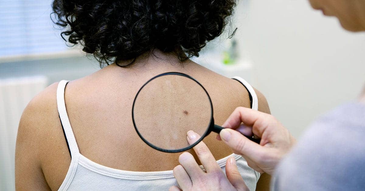 Why You Should Get a Skin Cancer Screening at the End of Summer