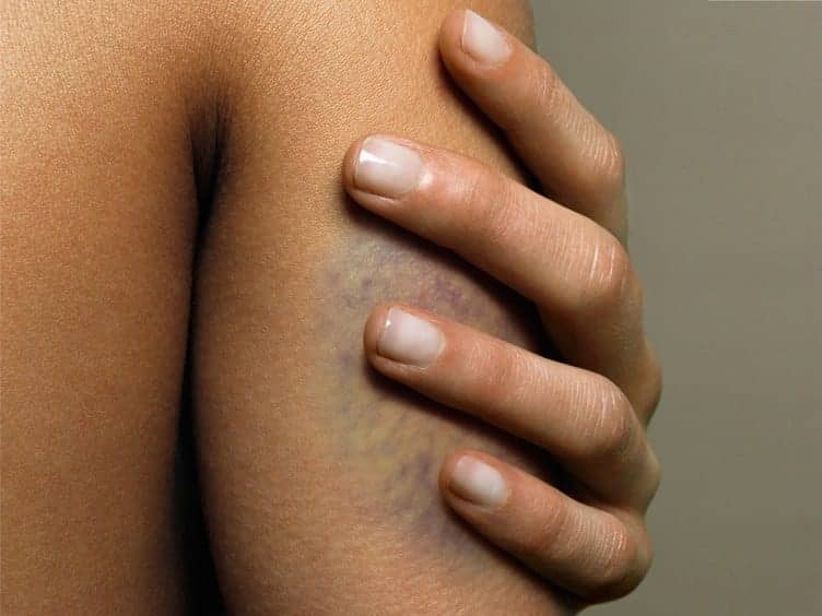 Here Are the Only Ways to Actually Get Rid of a Bruise Faster