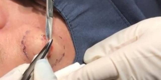 Dr. Pimple Popper Shares More of Her Best 2017 Pops