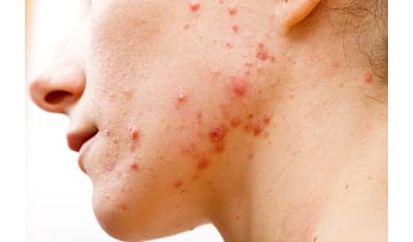 Acne Linked with Increased Risk of Depression