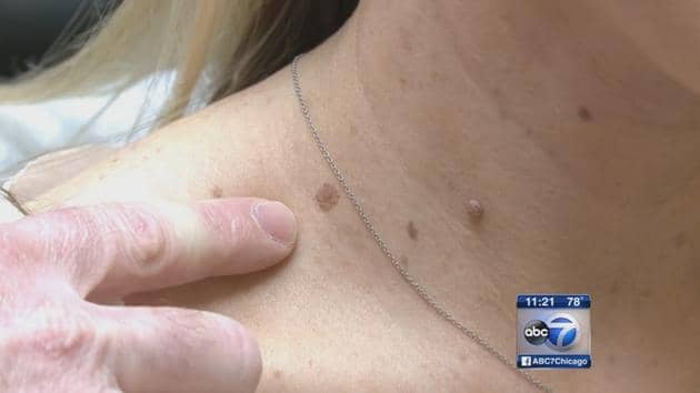 4 Tips from Dermatologists to Avoid Skin Cancer