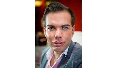 Plastic Surgery Addict Insures Body For A Million Pounds After Nose Job Went Wrong