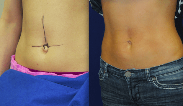 The Tiny Little Body Part People Want Plastic Surgery On