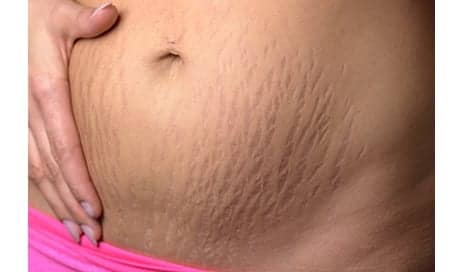 Can You Fade Your Stretch Marks?