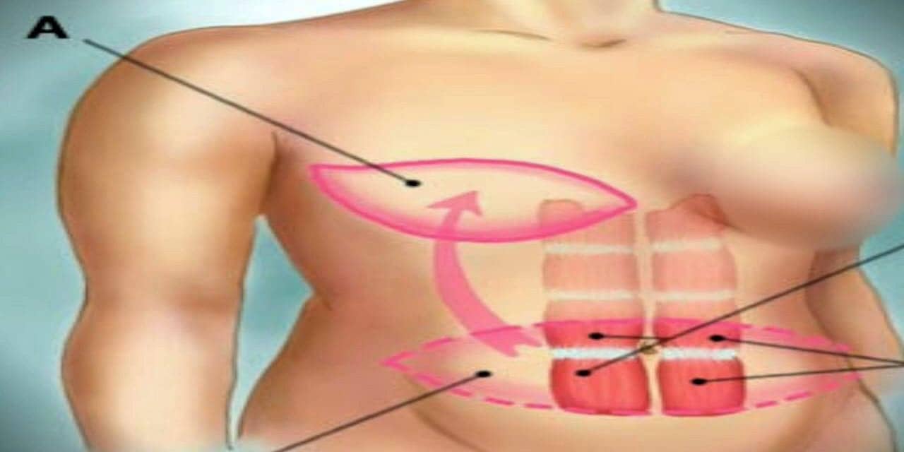 Reconstructive Surgery Without the Implants