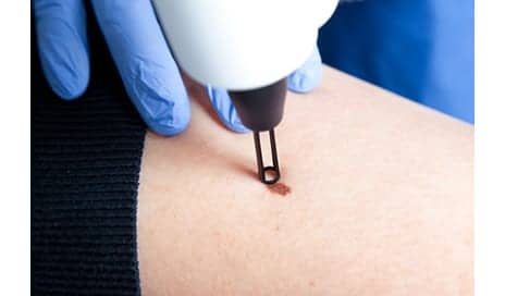 Recent Developments in Dermatological Lasers