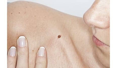 A Changing Mole Is Sometimes a Sign of Skin Cancer