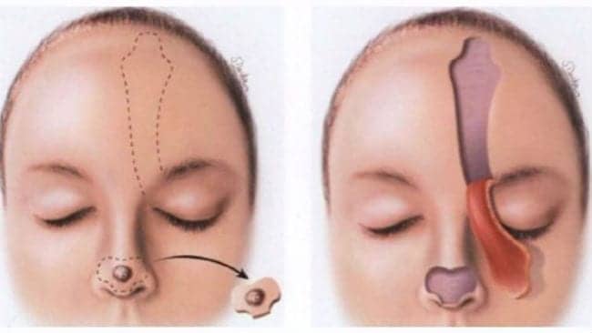 Plastic Surgery Repairs Melanoma Damage