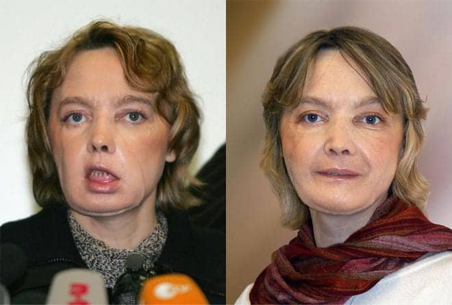 The World’s First Face Transplant Patient Dies at 49