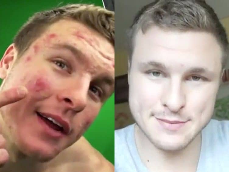 This Man's Acne Basically Disappeared When He Stopped Eating Dairy