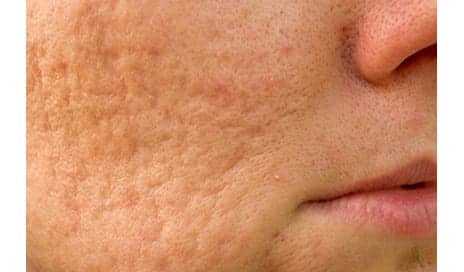 Single-Session Combination Therapy Successfully Treats Rolling Acne Scars