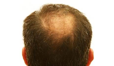 Cell-Enriched Fat May Represent Alternative for Treating Pattern Hair Loss