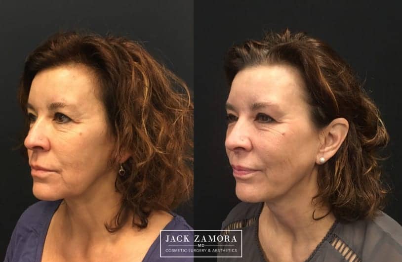 Denver women to Show Off Inventive New Facelifts On National Daytime TV Show, “The Doctors”