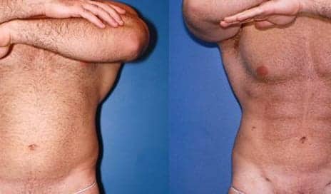 Male Plastic Surgery Skyrocketing With Pricey 'Daddy-Do-Overs'