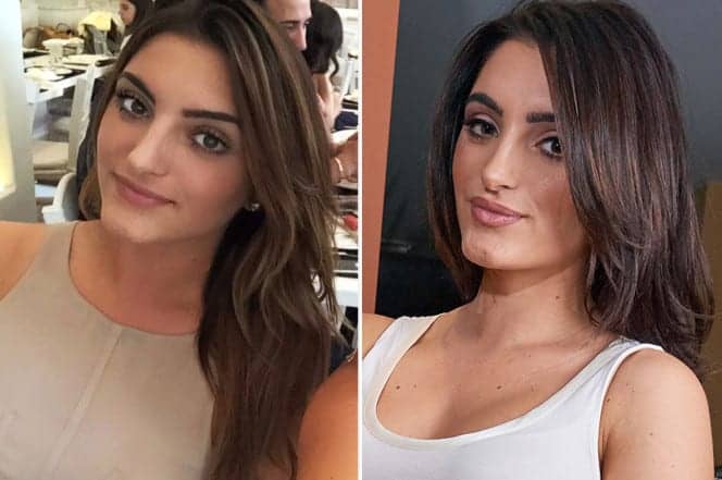 Millennials Aren’t Shy About Plastic Surgery on Instagram