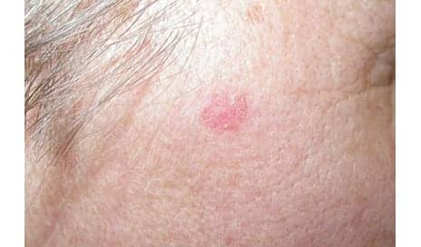 Skin Cream Shows Promise in Treating Basal Cell Carcinoma