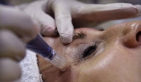 What is Microneedling and Why is it Gaining Popularity?