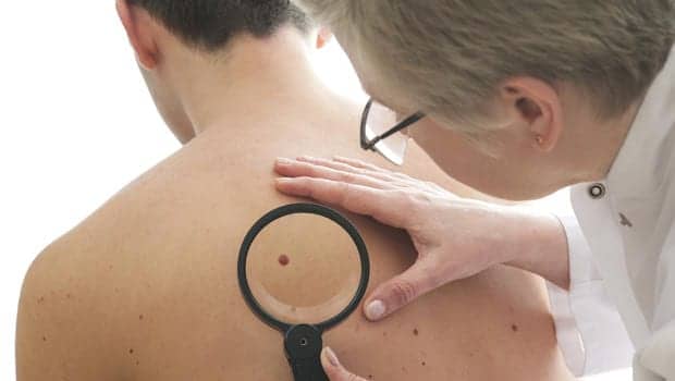 Melanoma Skin Cancer Diagnoses, Deaths Steadily Climbing