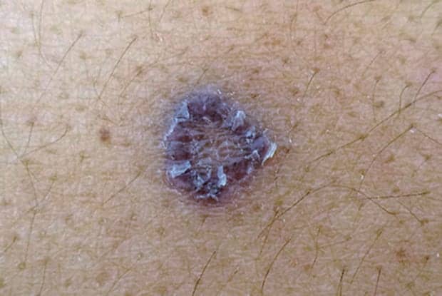 Case Study: A New, Solitary Lesion on Pigmented Skin