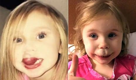 Life-Changing Surgery Offers Hope for Toddler with Debilitating Facial Birthmark