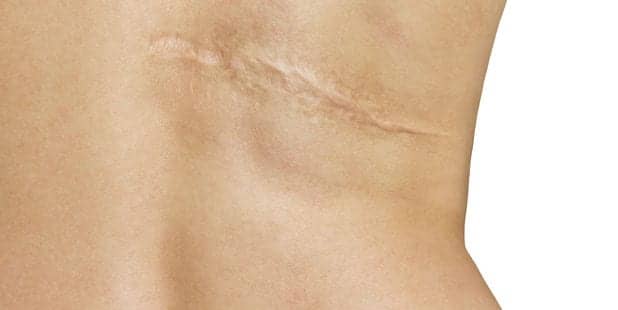 An End to Scars? Breakthrough Could Heal Wounds Without Leaving a Trace