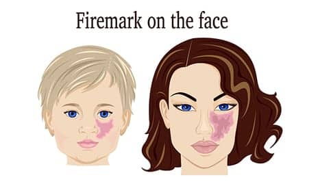 Facial Port-Wine Stains Have Significant Impact On Quality of Life