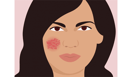 Eczema Treatment: What You Can Do To Stop The Incessant Itch