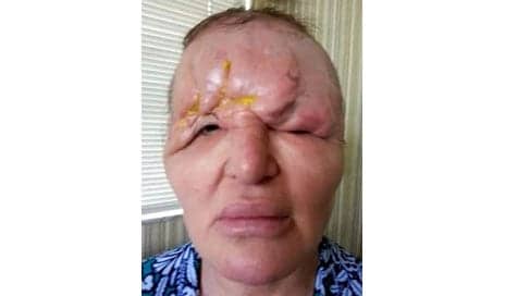 Florida Woman Left Suicidal, Feeling “Like a Monster” After Suffering Partial Blindness, Collapsed Forehead from Botched Botox