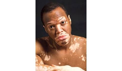 Vitiligo: A Skin Condition You Shouldn’t Ignore