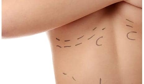 How I Feel About My Decision to Get Cosmetic Surgery – 10 Years On
