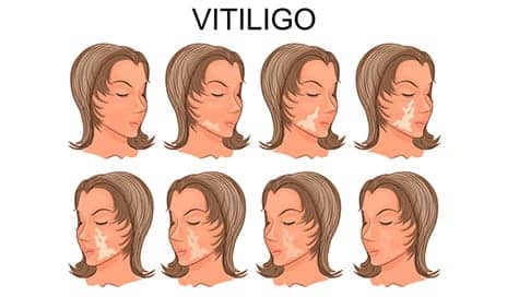 Vitiligo Linked to Moles, Tanning Ability, Blistering Sunburn