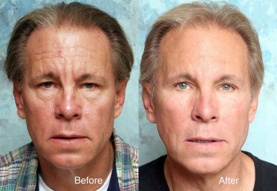 'Bro-tox' Boom: Demand Up for Nonsurgical Options