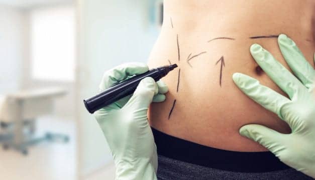 Everything You Ever Wanted To Know (But Were Too Afraid To Ask) About Liposuction