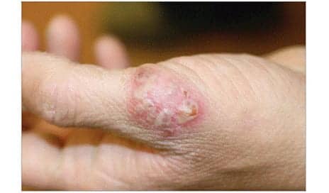 A Tender Rash on the Hand