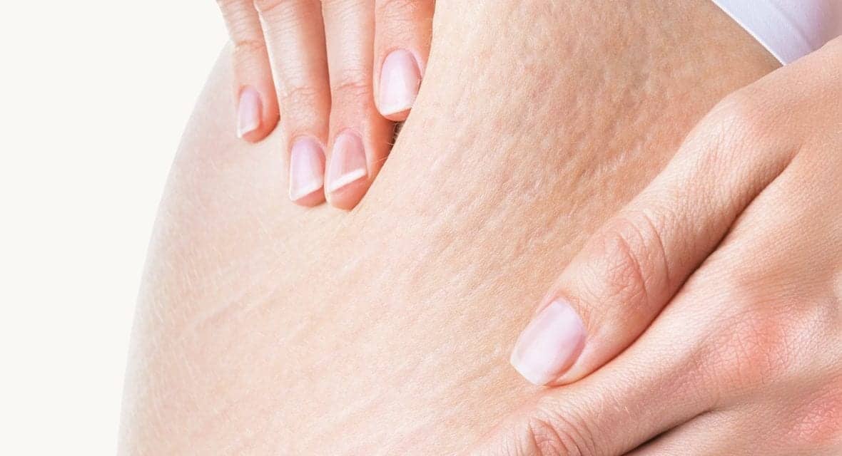 How to Minimize the Appearance of Stretch Marks, According to Dermatologists