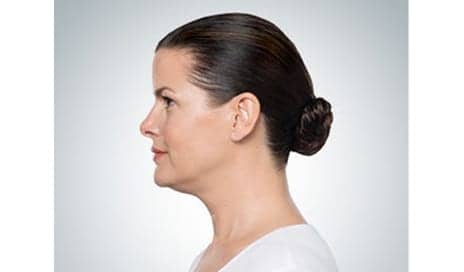 Can You Eliminate a Double Chin Without Surgery?