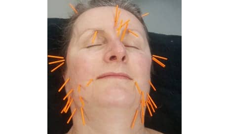 Could Sticking 35 Needles in Your Face Really Have So Many Benefits? Let’s See…