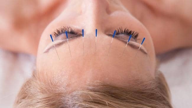 Is Acupuncture The New Botox?