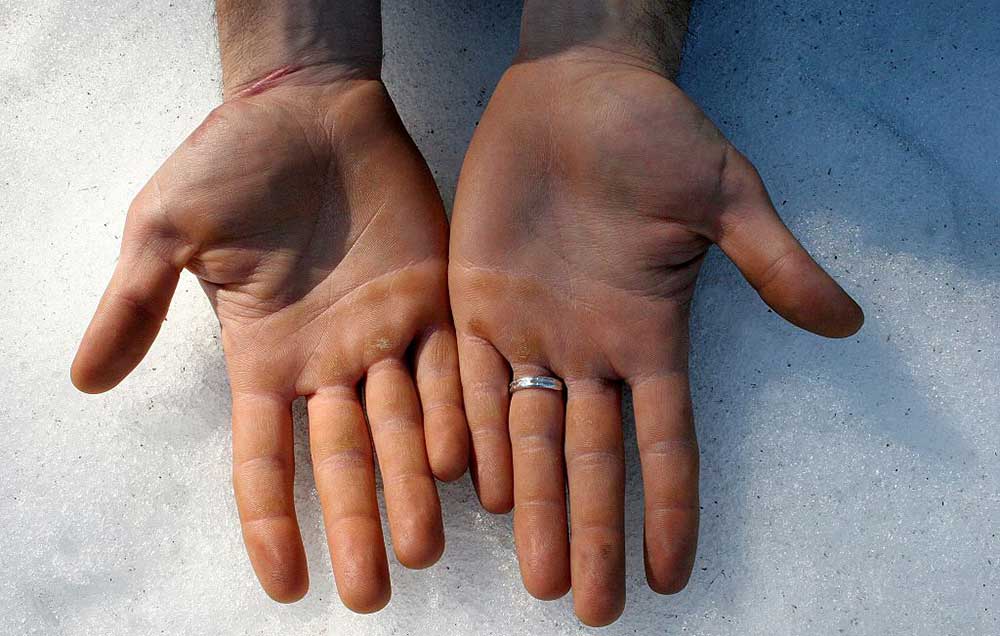 Sweaty Palms? You Can Fix It, But You Won’t Believe How