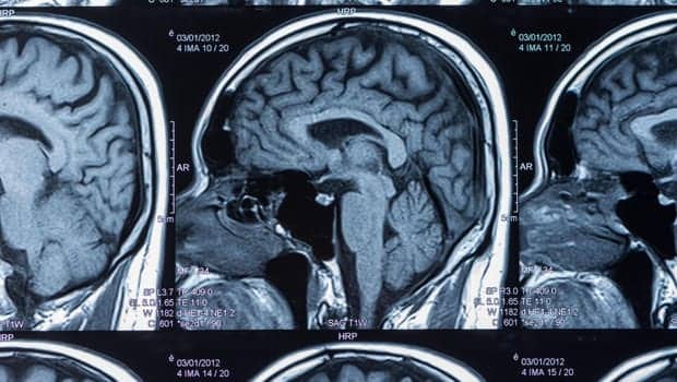 Brain Scans May Reveal Mental Secret of “Super Agers”