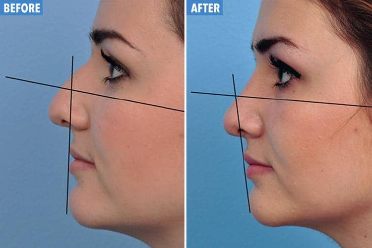 Want to Plump Up Your Lips But Terrified of a ‘Trout Pout’? A Nose Job Might Be the Answer, Say Plastic Surgeons
