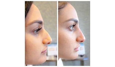I Got A Nose Job In 5 Minutes — & It Didn't Hurt At All