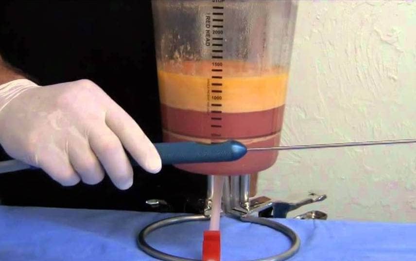 Plastic Surgery Goes Green With ‘Fat Recycling’