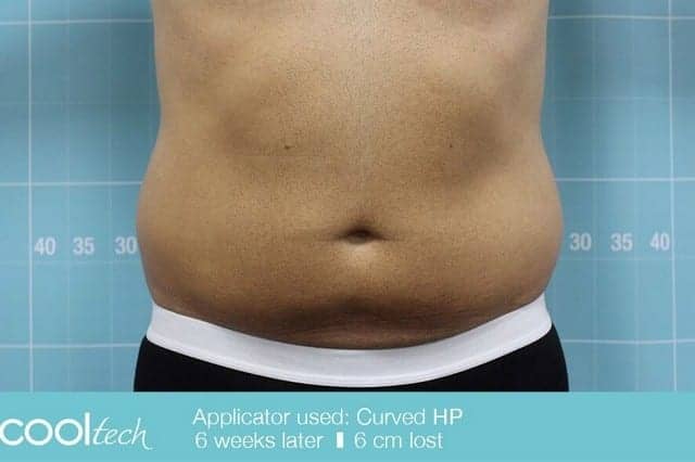 The Pros and Cons of the Non-Surgical Procedures That Promise the Body of Your Dreams