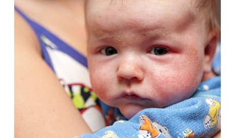 When Treating Eczema in Babies, the “Wet Look” is In