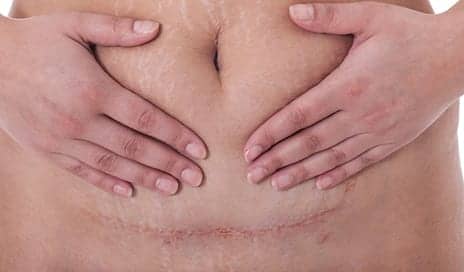 Why Does My C-Section Scar Feel Numb? A Dermatologist Weighs In