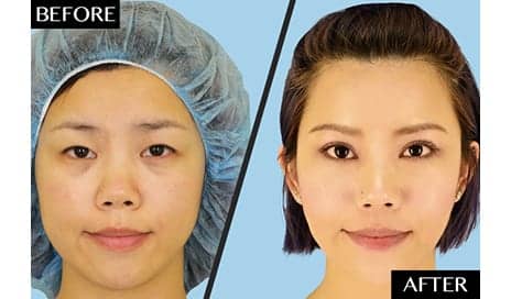 Plastic Surgeons Dispel the Common Misconception Behind Asian Double Eyelid Surgery
