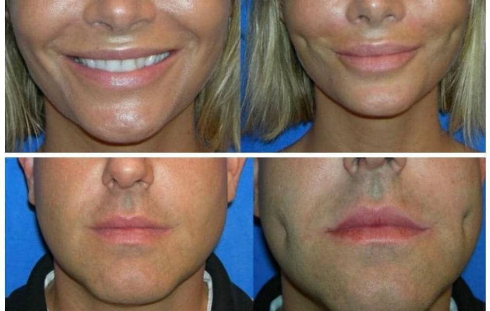 Dimpleplasty Is the New Plastic Surgery Trend Among Millennials